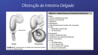 Obstrução do Intestino Delgado
 