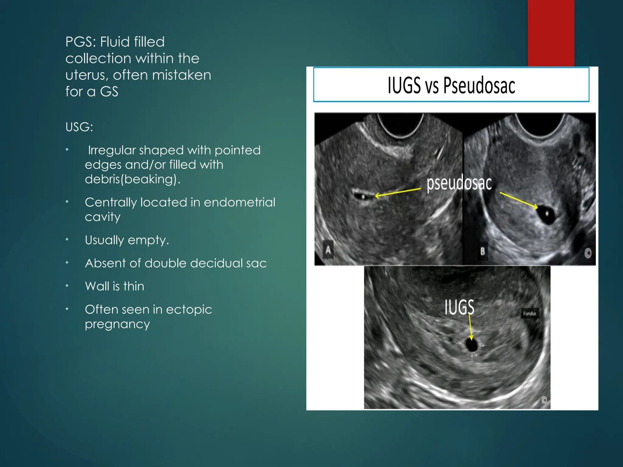 PGS: Fluid filled
collection within the
uterus, often mistaken
for a GS
USG:
• Irregular shaped with pointed
edges and/or filled with
debris(beaking).
• Centrally located in endometrial
cavity
• Usually empty.
• Absent of double decidual sac
• Wall is thin
• Often seen in ectopic
pregnancy
 