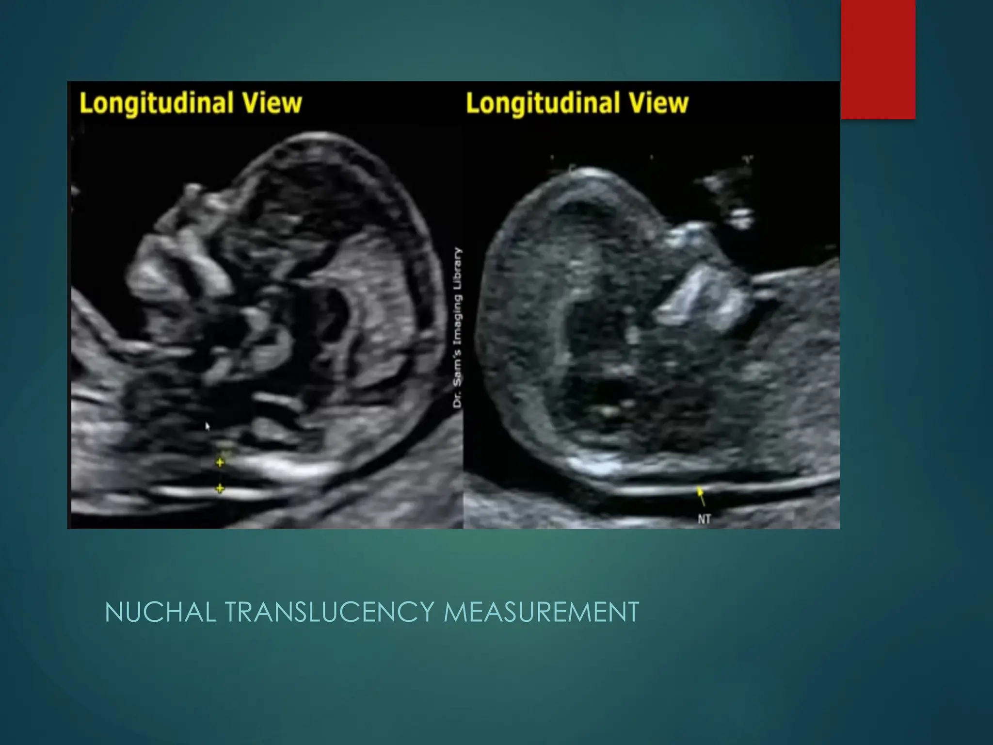 NUCHAL TRANSLUCENCY MEASUREMENT
 