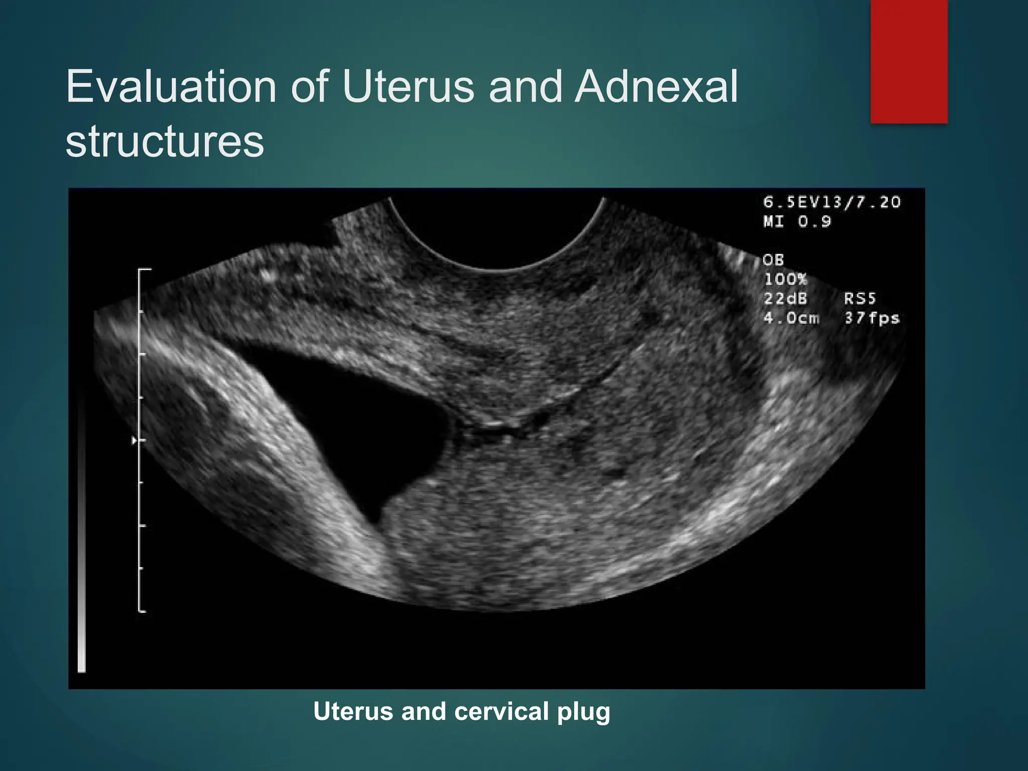 Evaluation of Uterus and Adnexal
structures
Uterus and cervical plug
 