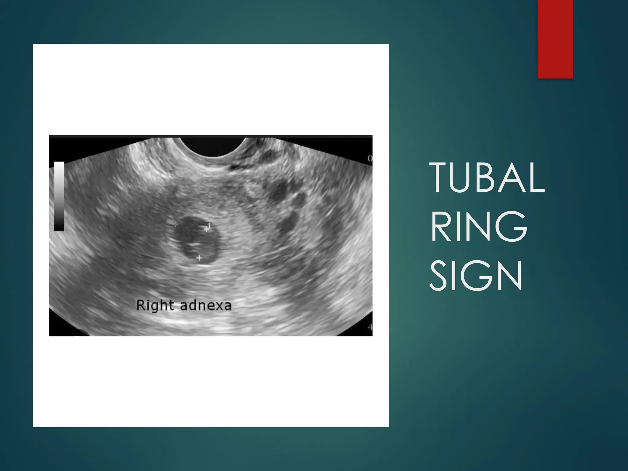 TUBAL
RING
SIGN
 