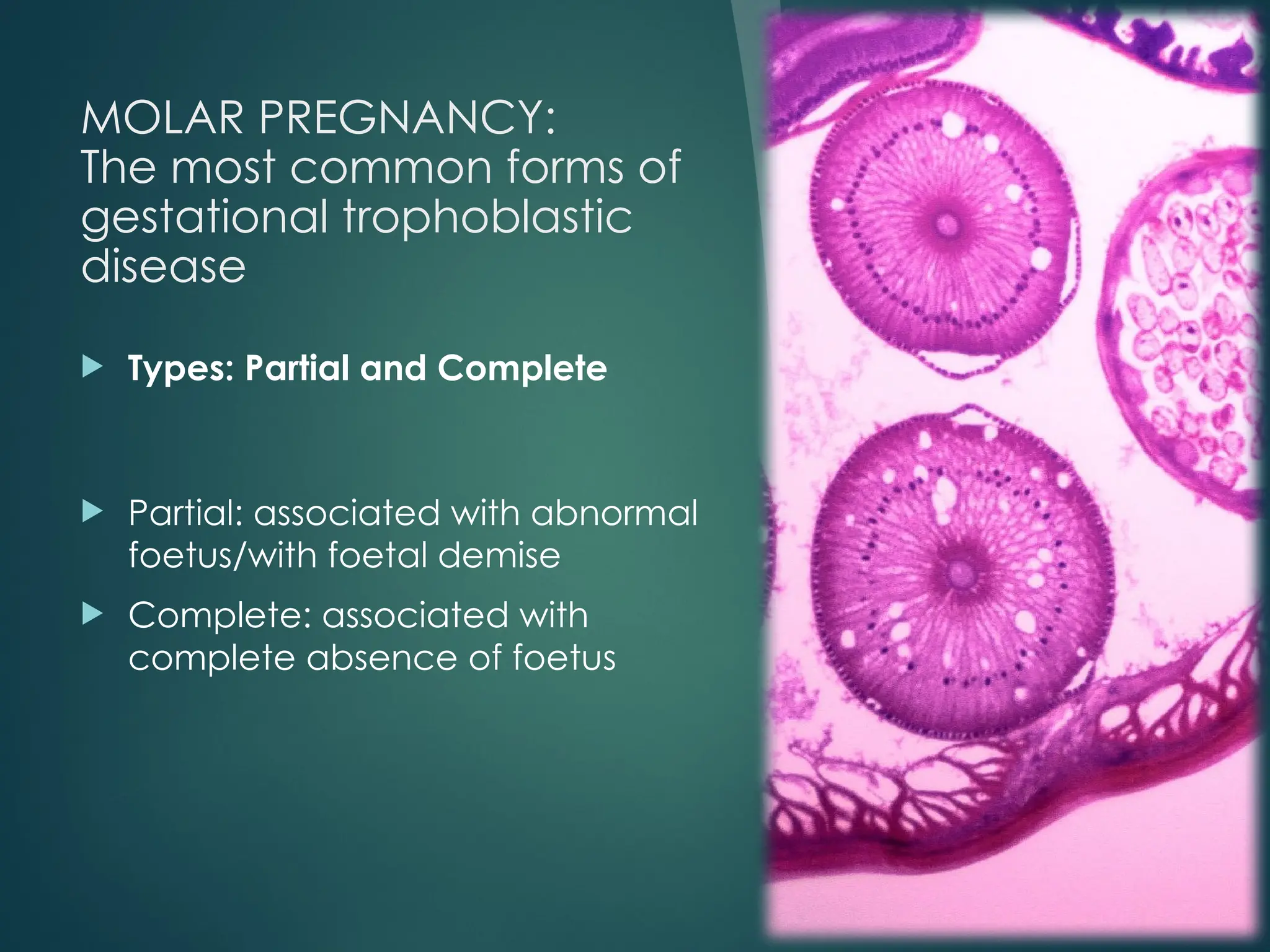 MOLAR PREGNANCY:
The most common forms of
gestational trophoblastic
disease
 Types: Partial and Complete
 Partial: associated with abnormal
foetus/with foetal demise
 Complete: associated with
complete absence of foetus
 
