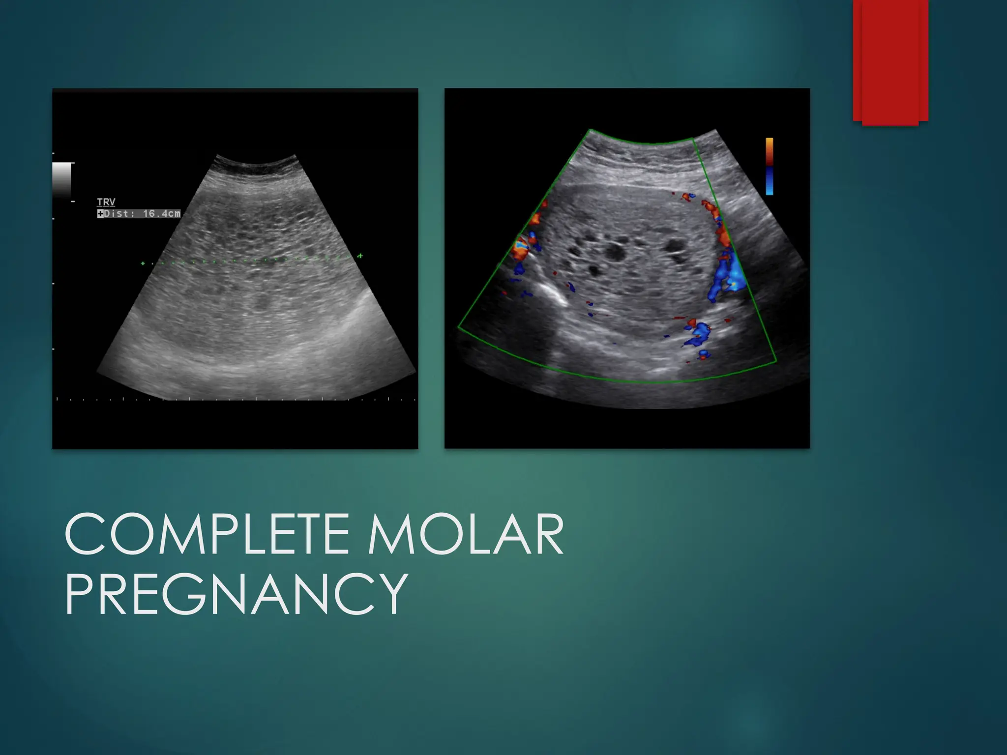 COMPLETE MOLAR
PREGNANCY
 