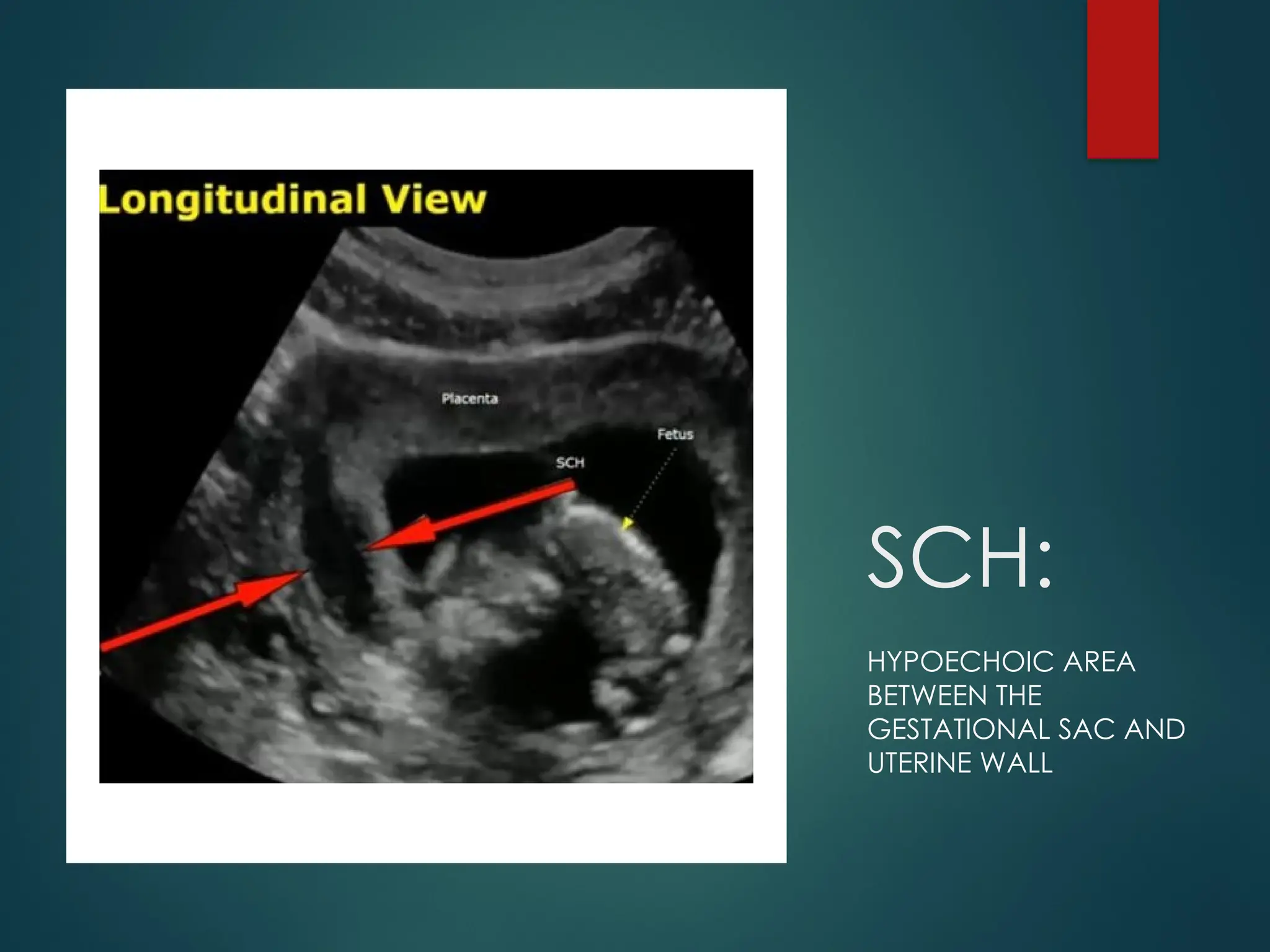 SCH:
HYPOECHOIC AREA
BETWEEN THE
GESTATIONAL SAC AND
UTERINE WALL
 