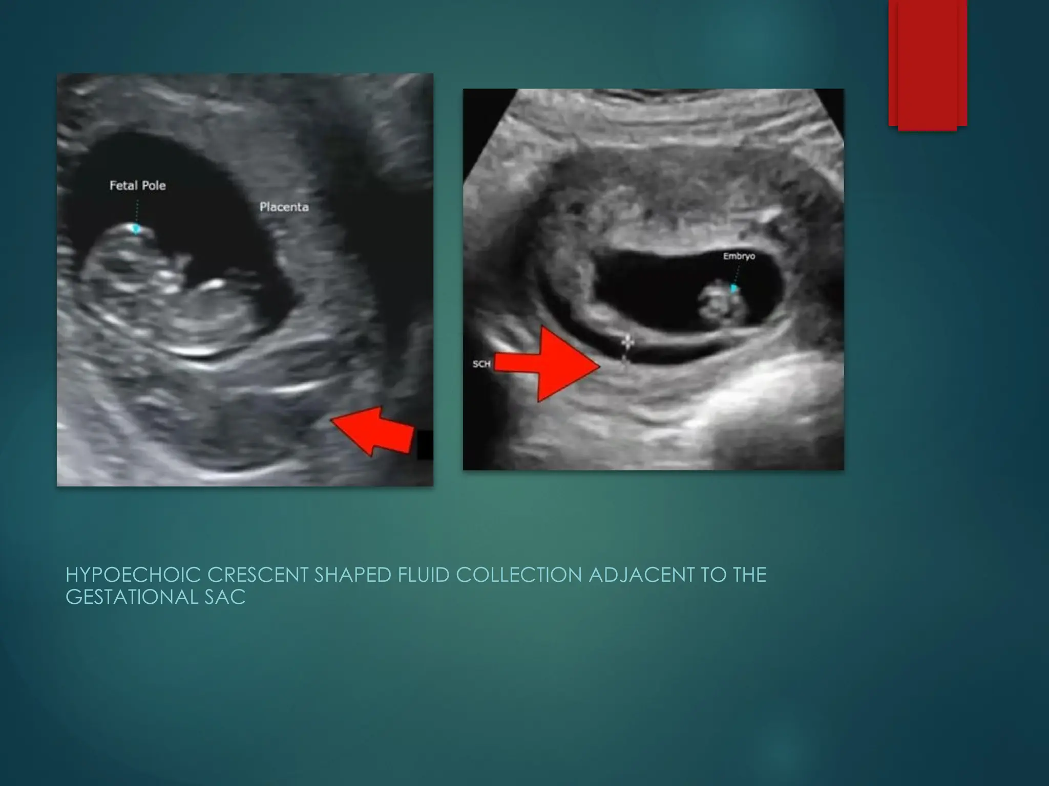 HYPOECHOIC CRESCENT SHAPED FLUID COLLECTION ADJACENT TO THE
GESTATIONAL SAC
 