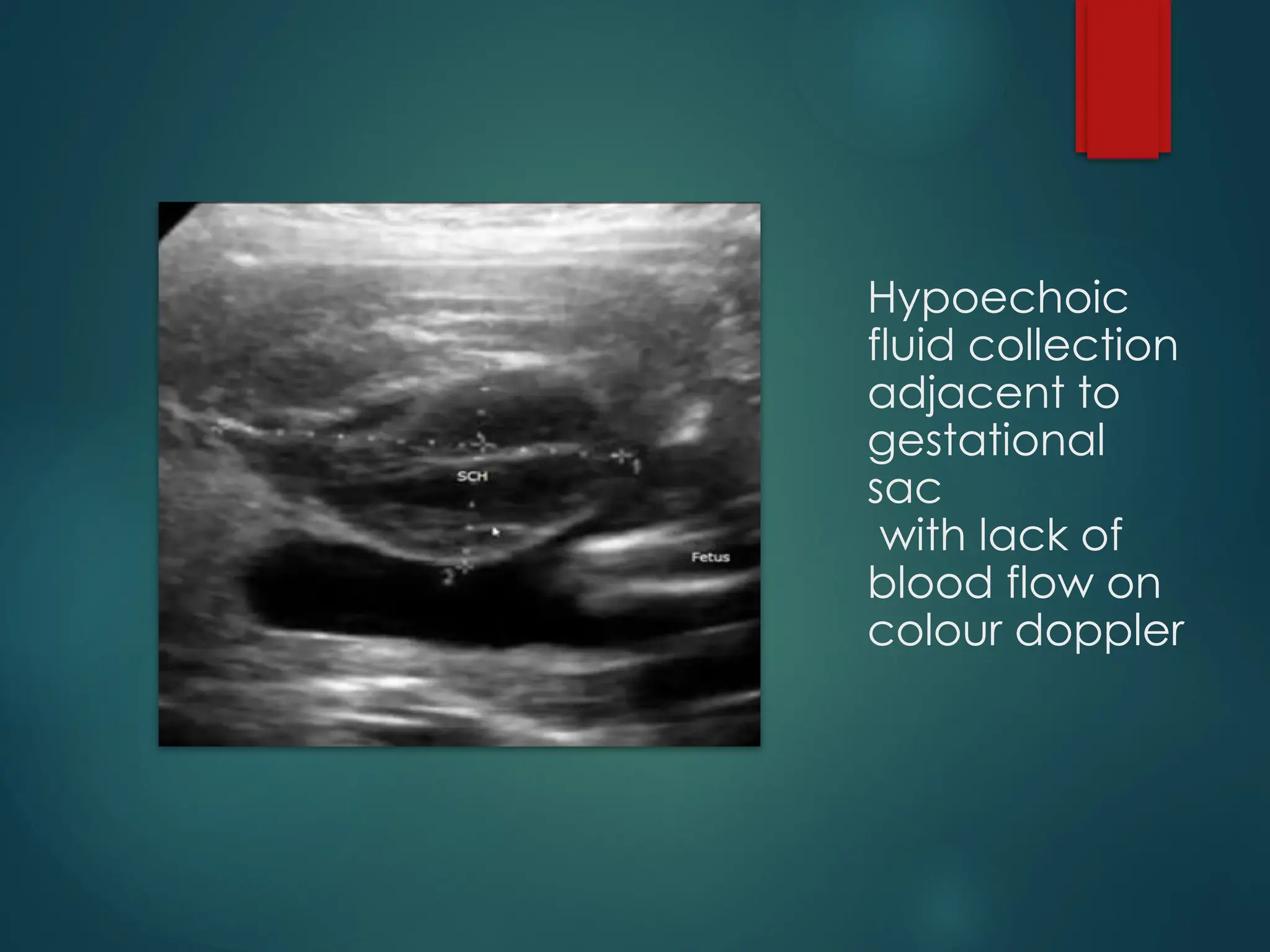 Hypoechoic
fluid collection
adjacent to
gestational
sac
with lack of
blood flow on
colour doppler
 