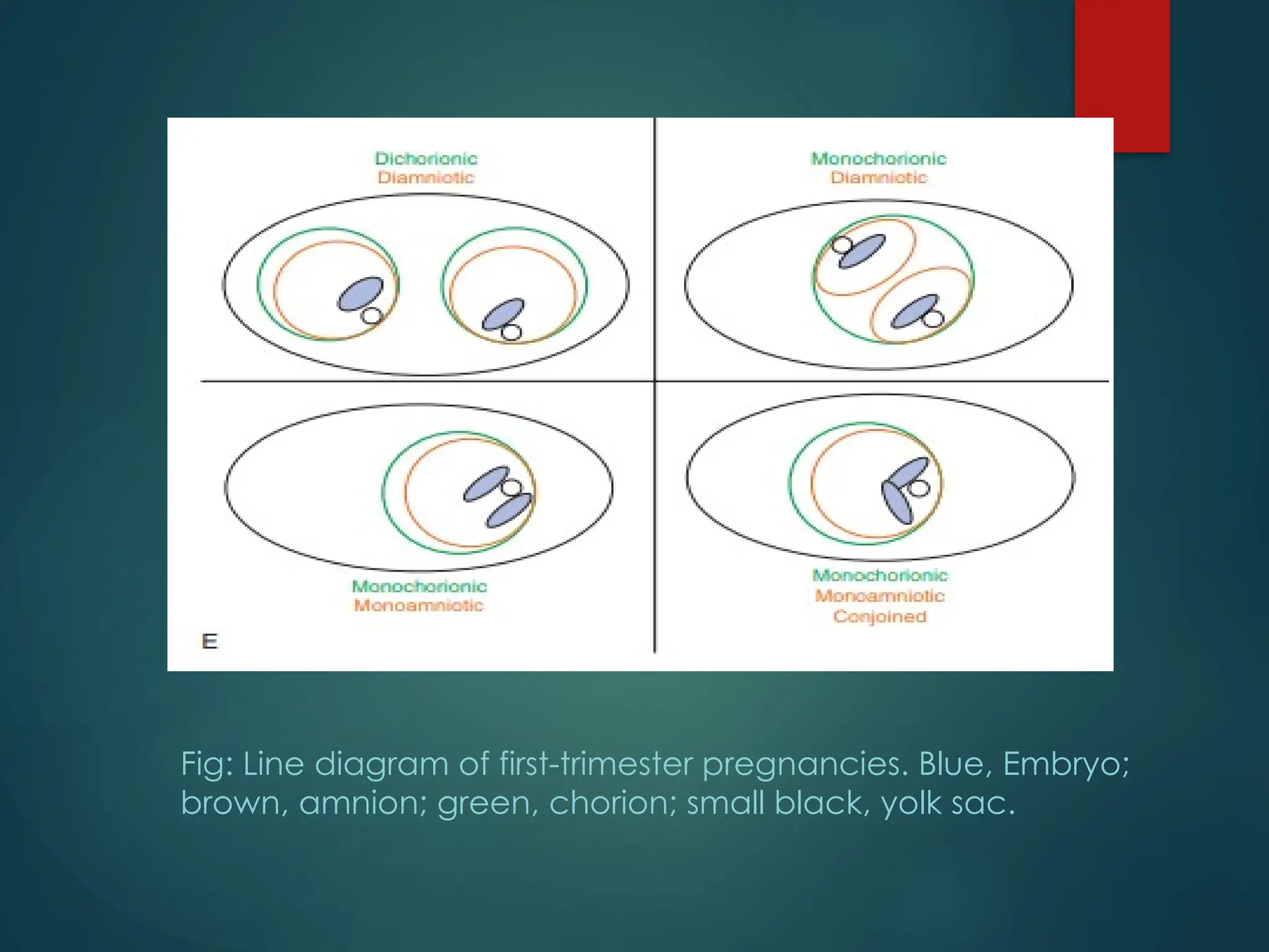 Fig: Line diagram of first-trimester pregnancies. Blue, Embryo;
brown, amnion; green, chorion; small black, yolk sac.
 