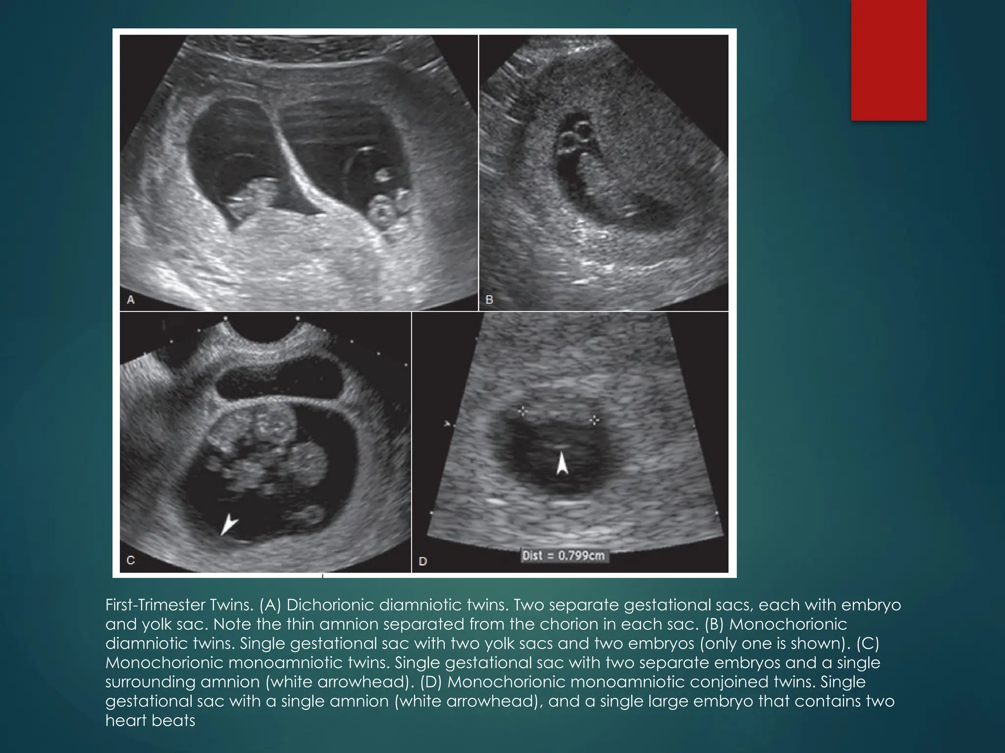 First-Trimester Twins. (A) Dichorionic diamniotic twins. Two separate gestational sacs, each with embryo
and yolk sac. Note the thin amnion separated from the chorion in each sac. (B) Monochorionic
diamniotic twins. Single gestational sac with two yolk sacs and two embryos (only one is shown). (C)
Monochorionic monoamniotic twins. Single gestational sac with two separate embryos and a single
surrounding amnion (white arrowhead). (D) Monochorionic monoamniotic conjoined twins. Single
gestational sac with a single amnion (white arrowhead), and a single large embryo that contains two
heart beats
 