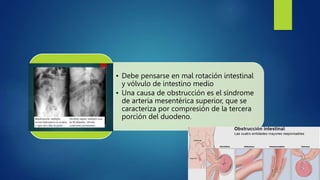 • Debe pensarse en mal rotación intestinal
y vólvulo de intestino medio
• Una causa de obstrucción es el síndrome
de arteria mesentérica superior, que se
caracteriza por compresión de la tercera
porción del duodeno.
 