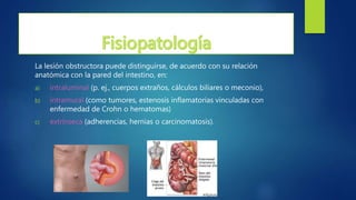La lesión obstructora puede distinguirse, de acuerdo con su relación
anatómica con la pared del intestino, en:
a) intraluminal (p. ej., cuerpos extraños, cálculos biliares o meconio),
b) intramural (como tumores, estenosis inflamatorias vinculadas con
enfermedad de Crohn o hematomas)
c) extrínseca (adherencias, hernias o carcinomatosis).
 