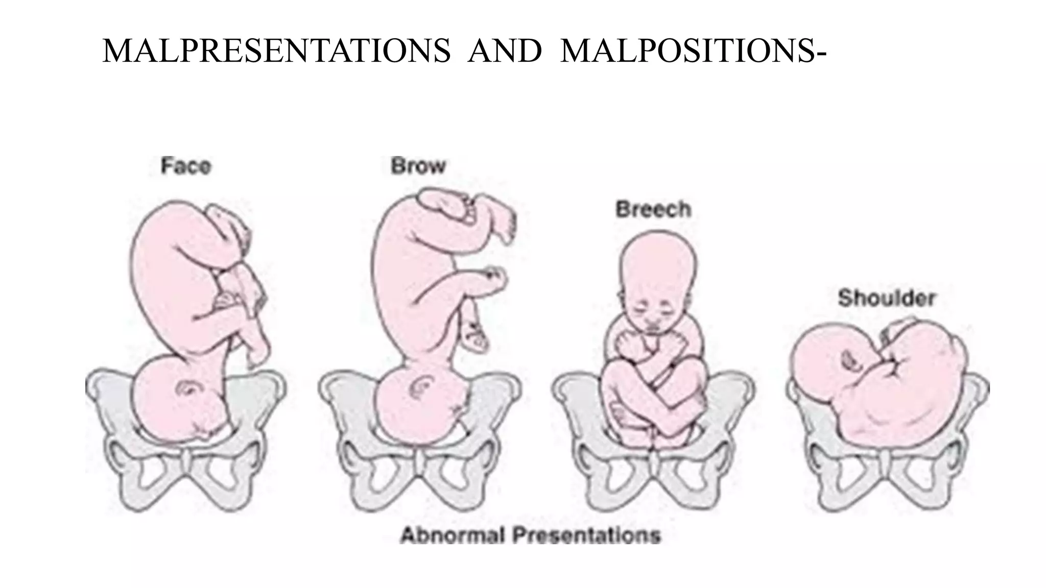 MALPRESENTATIONS AND MALPOSITIONS-
 