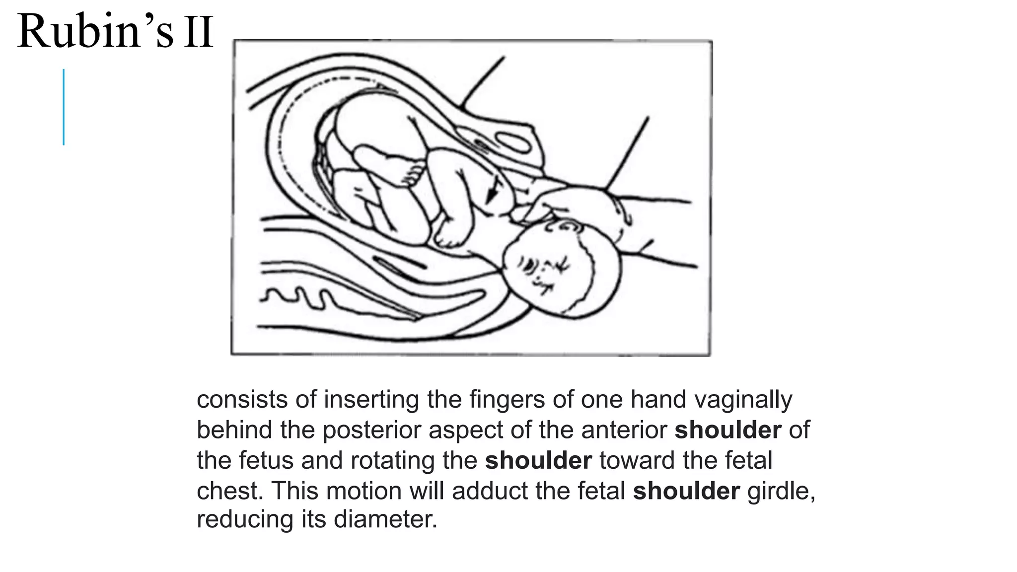 Rubin’s II
consists of inserting the fingers of one hand vaginally
behind the posterior aspect of the anterior shoulder of
the fetus and rotating the shoulder toward the fetal
chest. This motion will adduct the fetal shoulder girdle,
reducing its diameter.
 