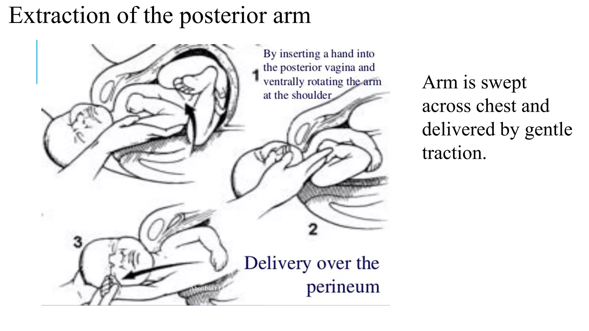 Extraction of the posterior arm
Arm is swept
across chest and
delivered by gentle
traction.
 