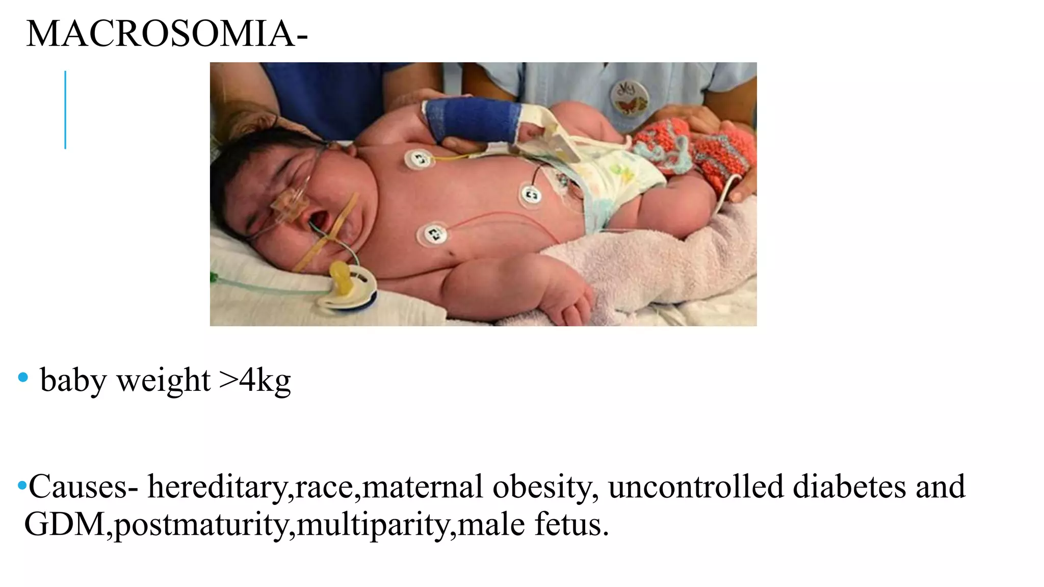MACROSOMIA-
• baby weight >4kg
•Causes- hereditary,race,maternal obesity, uncontrolled diabetes and
GDM,postmaturity,multiparity,male fetus.
 