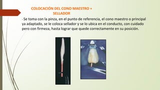 COLOCACIÓN DEL CONO MAESTRO +
SELLADOR
- Se toma con la pinza, en el punto de referencia, el cono maestro o principal
ya adaptado, se le coloca sellador y se lo ubica en el conducto, con cuidado
pero con firmeza, hasta lograr que quede correctamente en su posición.
 