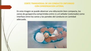 CORTE TRANSVERSAL DE UN CONDUCTO OBTURADO
CON CONDENSACION LATERAL
Prof. Dr. Omar Gani.
En esta imagen se puede observar una obturación bien compacta, los
conos de gutapercha comprimidos entre sí y el sellador (coloreado) como
interfase entre los conos y las paredes del conducto en cantidad
adecuada.
 