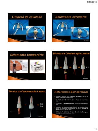 5/14/2010




                                                                                               Ana Araújo
                           Ana Araújo




                                        Técnica da Condensação Lateral




                                                                                                    RX




                                                                                              Ana Araújo




Técnica da Condensação Lateral
                                            COHEN, S.; BURNS, R. C. Caminhos da Polpa. 7. ed. Rio de
                                             Janeiro: Guanabara Koogan, 2000.

                                            DE DEUS, Q. D. Endodontia. 5ª ed. Rio de Janeiro: Medsi,
                                             1992.

                                            ESTRELA, C. Ciência Endodôntica. São Paulo: Artes Médicas,
                            RX               2004.
                           final
                                            GOMES et al. Descontaminação Química de Cones de Guta-
                                             Percha por diferentes concentrações de NaOCl. Revista da
                                             APCD, v.55., n.1, jan./fev., 2001.

                                            LOPES, H. P.; SIQUEIRA JR, J, F. Endodontia, Biologia e
                                             Técnica. Rio de Janeiro: Medsi, 1999.

                        Ana Araújo




                                                                                                            11
 