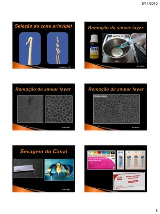 5/14/2010




Seleção do cone principal

                                                        NaOCl 2,5%




                                                                           Ana Araújo
                   Castellucci, 2007




                                       Erosão tubular




                       Ana Araújo                                    Ana Araújo




                       Ana Araújo




                                                                                         8
 