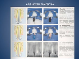 COLD LATERAL COMPACTION
 