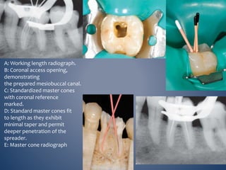 A: Working length radiograph.
B: Coronal access opening,
demonstrating
the prepared mesiobuccal canal.
C: Standardized master cones
with coronal reference
marked.
D: Standard master cones fit
to length as they exhibit
minimal taper and permit
deeper penetration of the
spreader.
E: Master cone radiograph
 