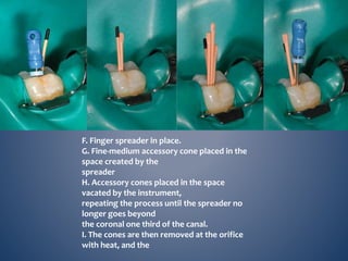 F. Finger spreader in place.
G. Fine-medium accessory cone placed in the
space created by the
spreader
H. Accessory cones placed in the space
vacated by the instrument,
repeating the process until the spreader no
longer goes beyond
the coronal one third of the canal.
I. The cones are then removed at the orifice
with heat, and the
 