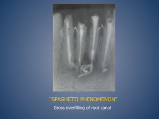 “SPAGHETTI PHENOMENON”
Gross overfilling of root canal
 