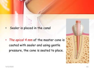 • Sealer is placed in the canal
• The apical 4 mm of the master cone is
coated with sealer and using gentle
pressure, the cone is seated to place.
5/11/2020 111
 