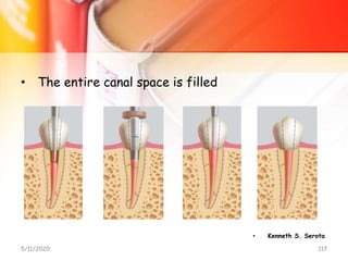 • The entire canal space is filled
5/11/2020 117
• Kenneth S. Serota
 