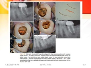 5/11/2020 9:21 AM OBTURATION 160
 