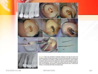 5/11/2020 9:21 AM OBTURATION 162
 