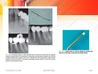 5/11/2020 9:21 AM OBTURATION 169
 