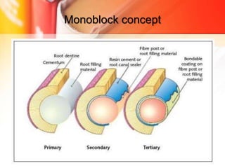 Monoblock concept
5/11/2020 9:21 AM OBTURATION 83
 