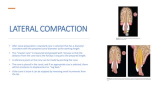 LATERAL COMPACTION
• After canal preparation a standard cone is selected that has a diameter
consistent with the prepared canal diameter at the working length.
• This “master cone” is measured and grasped with forceps so that the
distance from the cone tip to the forceps is equal to the prepared length.
• A reference point on the cone can be made by pinching the cone.
• The cone is placed in the canal, and if an appropriate size is selected, there
will be resistance to displacement or “tug back.”
• If the cone is loose it can be adapted by removing small increments from
the tip.
 