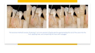 The sectional method consists of placing 3- to 4-mm sections of gutta-percha approximating the size of the canal into the
root, applying heat, and compacting the mass with a plugger.
 