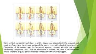 Warm vertical compaction technique: (a and b) Master cone adaptation in the prepared root
canal. (c) Severing of the coronal portion of the master cone with a heated instrument. (d)
Compaction of the master cone. (e) Sequential segments removed with the heat carrier
followed by compaction. (f-h) Once the apical third is reached, the canal is backfilled with
heated segments of gutta-percha followed compaction with suitable pluggers.
 