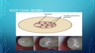 ROOT CANAL SEALERS
 