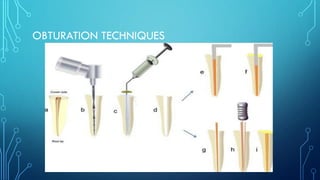 OBTURATION TECHNIQUES
 