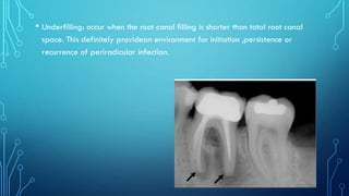 • Underfilling: occur when the root canal filling is shorter than total root canal
space. This definitely providean environment for initiation ,persistence or
recurrence of periradicular infection.
 