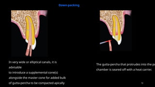 72
Down-packing
In very wide or elliptical canals, it is
advisable
to introduce a supplemental cone(s)
alongside the master cone for added bulk
of gutta-percha to be compacted apically
The gutta-percha that protrudes into the pu
chamber is seared off with a heat carrier.
 