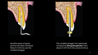 77
Another piece of gutta-
percha has been removed.
Now it is time to use the
smallest plugger.
The smallest plugger has advanced,
compacting the gutta-percha mass
about 5 mm from the canal terminus
 