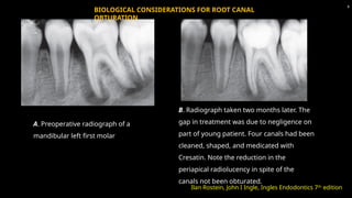 A. Preoperative radiograph of a
mandibular left first molar
B. Radiograph taken two months later. The
gap in treatment was due to negligence on
part of young patient. Four canals had been
cleaned, shaped, and medicated with
Cresatin. Note the reduction in the
periapical radiolucency in spite of the
canals not been obturated.
Ilan Rostein, John I Ingle, Ingles Endodontics 7th
edition
9
BIOLOGICAL CONSIDERATIONS FOR ROOT CANAL
OBTURATION
 