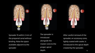 92
Spreader fit within 2 mm of
the prepared canal without
binding. Note the space
available adjacent to the
spreader
The spreader is
introduced
alongside the
master cone to the
proper apical
depth.
After careful removal of the
spreader, an accessory cone,
lightly coated with sealer, is
introduced to the apical depth
created by the spreader.
 