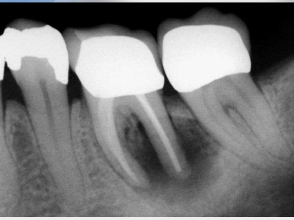 Obturation and the Importance of Coronal Seal