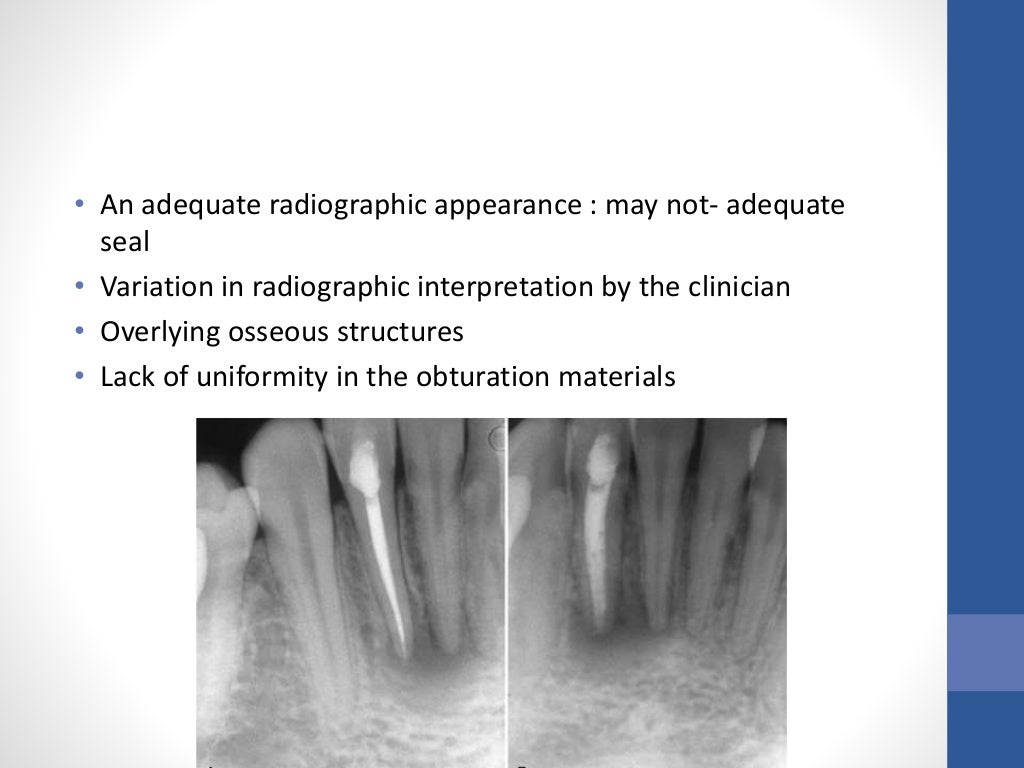 Root Canal Obturation general concepts principles