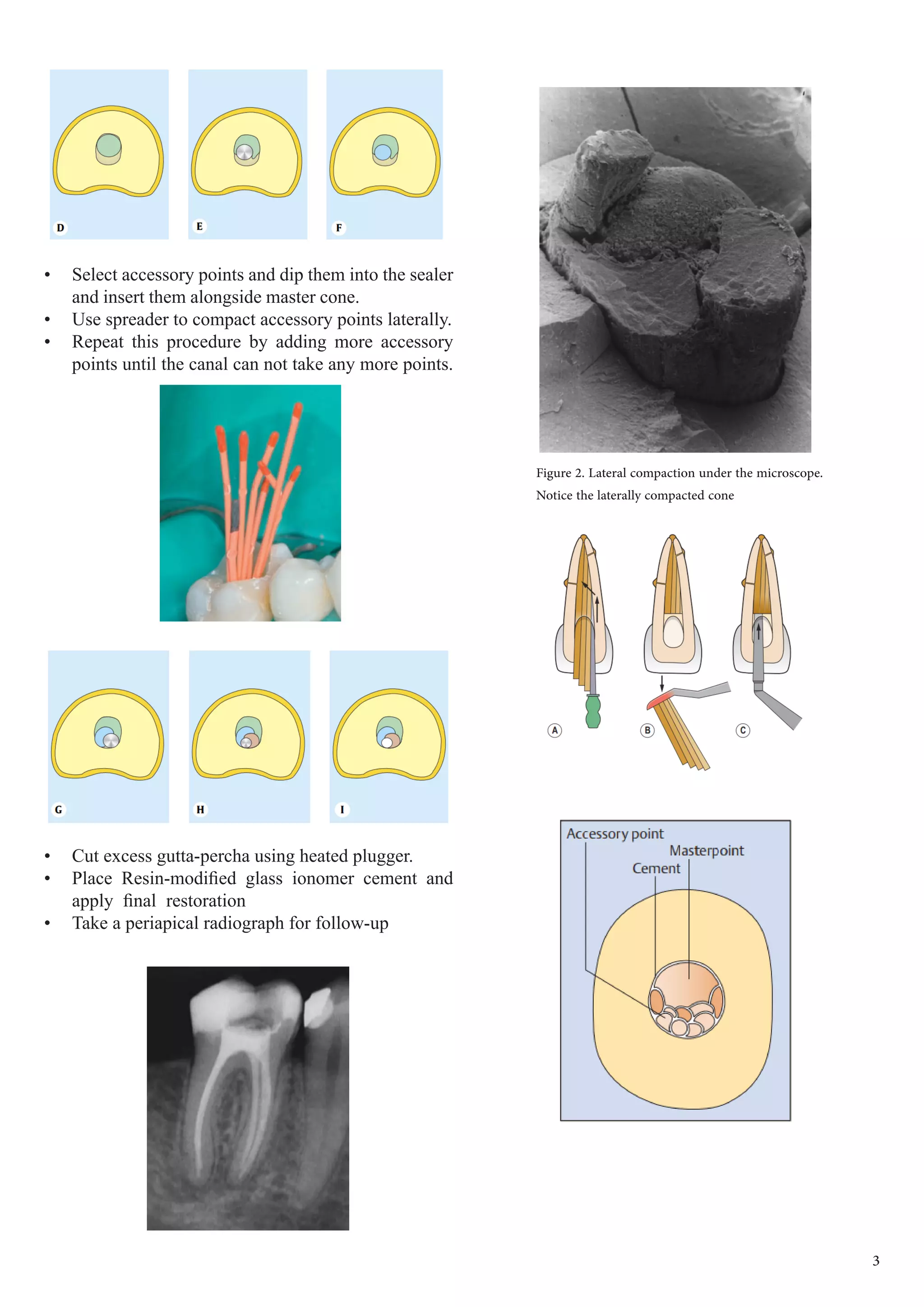 •	 Select accessory points and dip them into the sealer
and insert them alongside master cone.
•	 Use spreader to compact accessory points laterally.
•	 Repeat this procedure by adding more accessory
points until the canal can not take any more points.
•	 Cut excess gutta-percha using heated plugger.
•	 Place Resin-modified glass ionomer cement and
apply final restoration
•	 Take a periapical radiograph for follow-up
3
Figure 2. Lateral compaction under the microscope.
Notice the laterally compacted cone
 