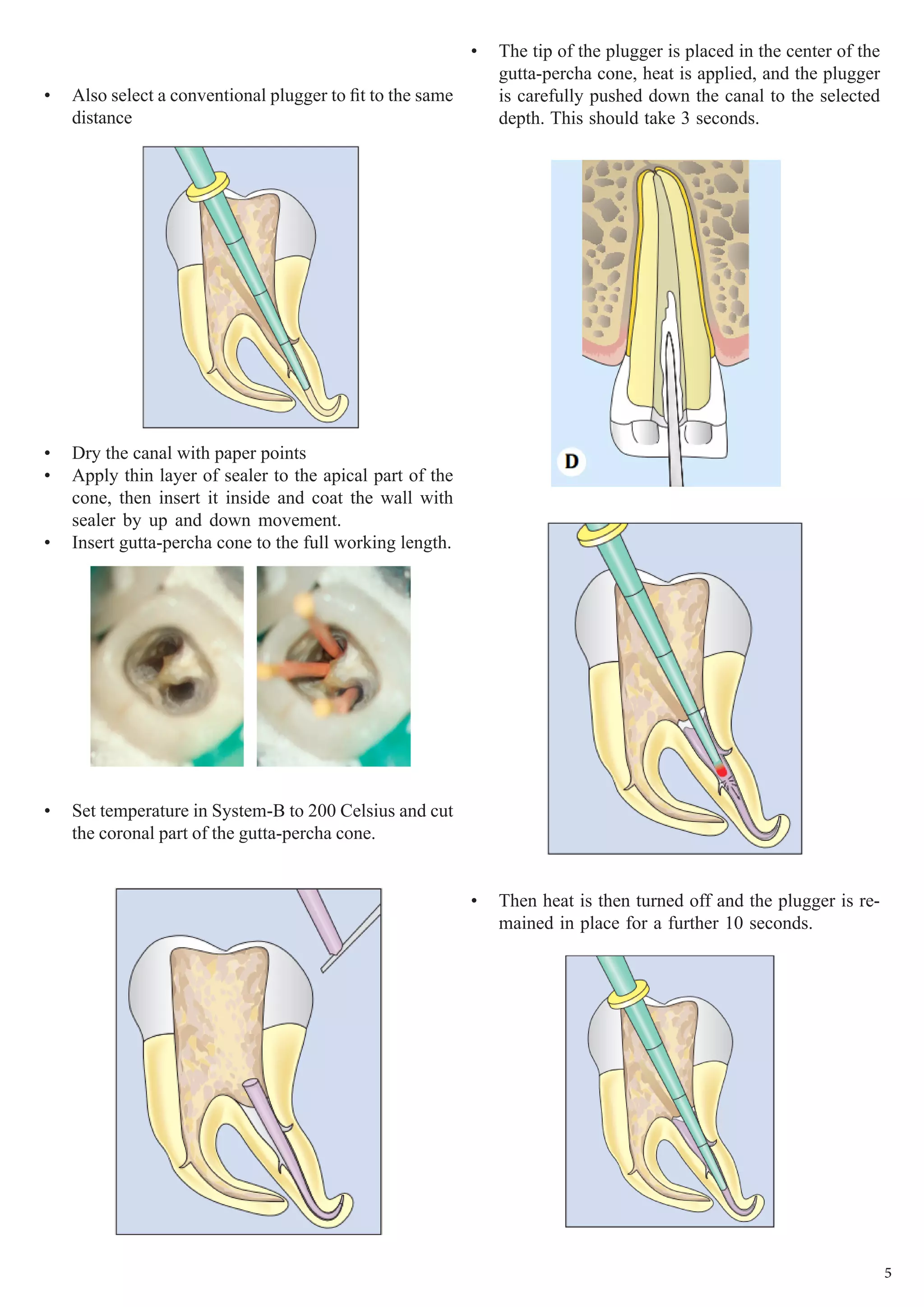 5
•	 Also select a conventional plugger to fit to the same
distance
•	 Dry the canal with paper points
•	 Apply thin layer of sealer to the apical part of the
cone, then insert it inside and coat the wall with
sealer by up and down movement.
•	 Insert gutta-percha cone to the full working length.
•	 Set temperature in System-B to 200 Celsius and cut
the coronal part of the gutta-percha cone.
•	 The tip of the plugger is placed in the center of the
gutta-percha cone, heat is applied, and the plugger
is carefully pushed down the canal to the selected
depth. This should take 3 seconds.
•	 Then heat is then turned off and the plugger is re-
mained in place for a further 10 seconds.
 