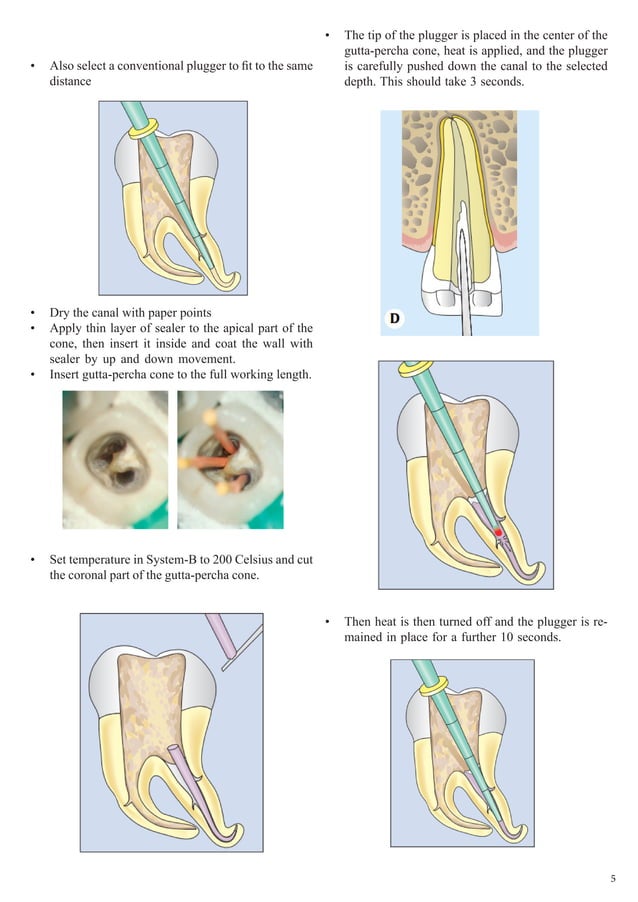 Obturation of Root Canal An Endodontic Overview PDF