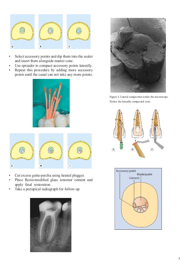 Obturation of Root Canal An Endodontic Overview