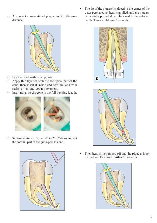 Obturation of Root Canal An Endodontic Overview