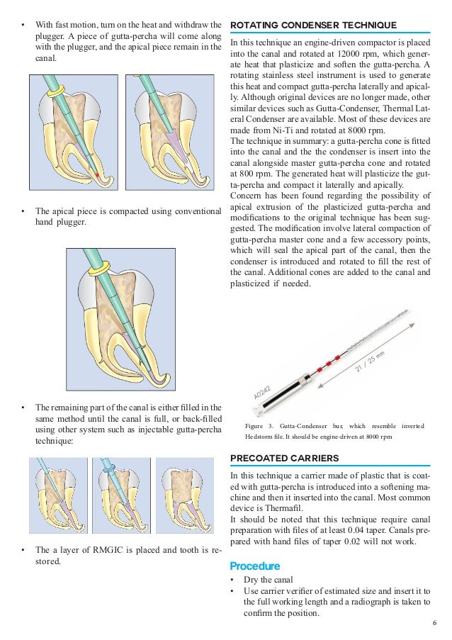 Obturation of Root Canal An Endodontic Overview